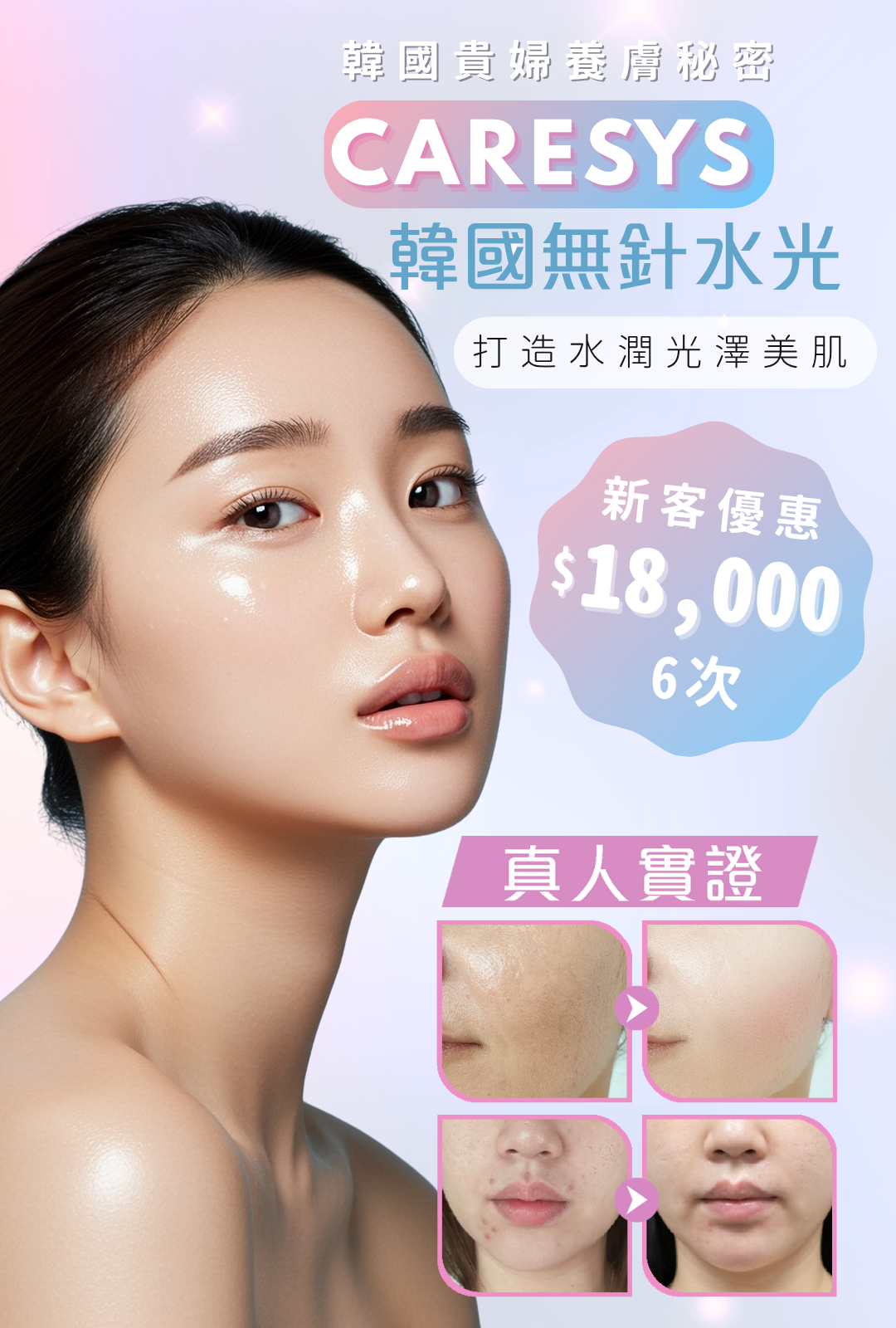 Caresys 無針水光槍