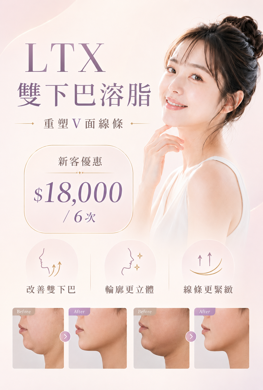 LTX雙下巴溶脂